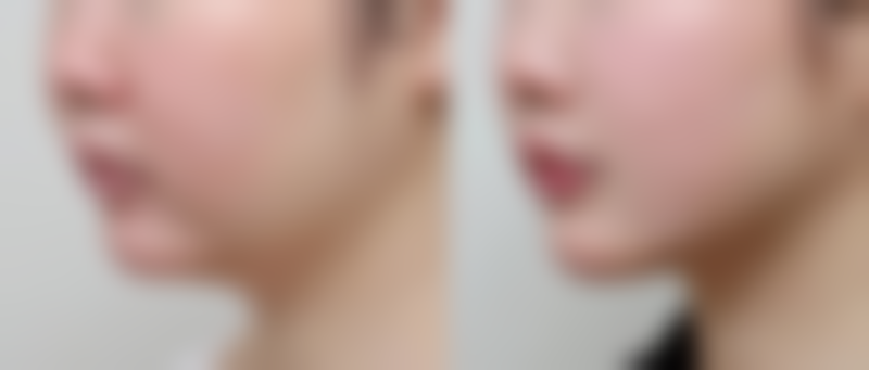 如何根据眼袋类型挑选去眼袋产品?精细出击