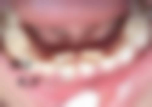 疤痕膏对手术疤痕有改善作用吗？揭秘不同成分功效及使用要点助疤痕修复 