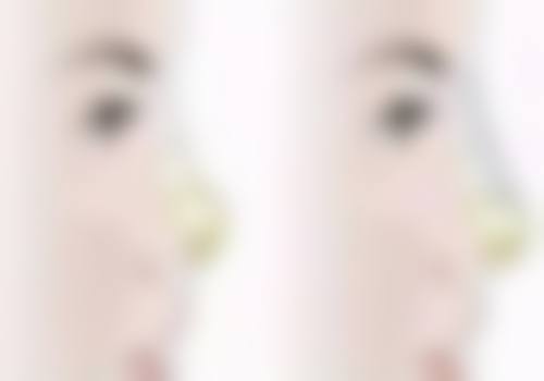 怎样让双眼皮快速消肿？术后护理是关键