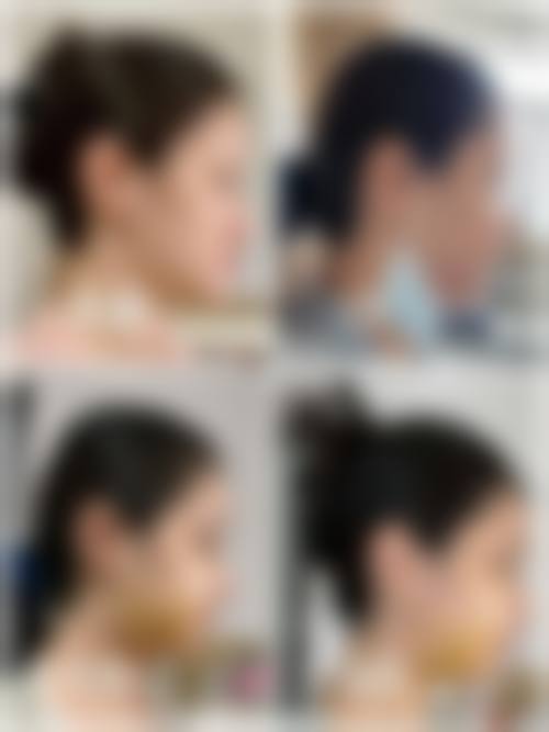 田军纯韩翘睫双眼皮实例