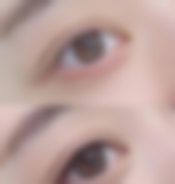 眼袋消肿时间大揭秘：最短 7 - 10 天，影响因素及医院优质服务助你速恢复 