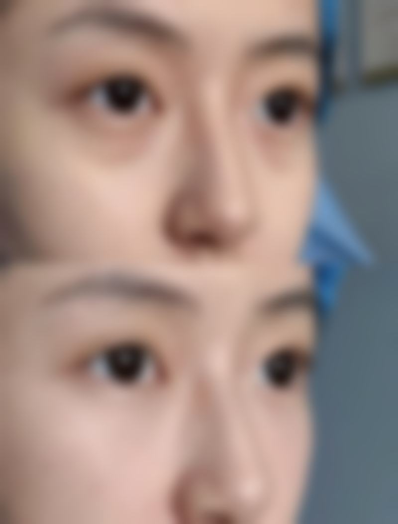 怎样让双眼皮快速消肿？术前准备不可少