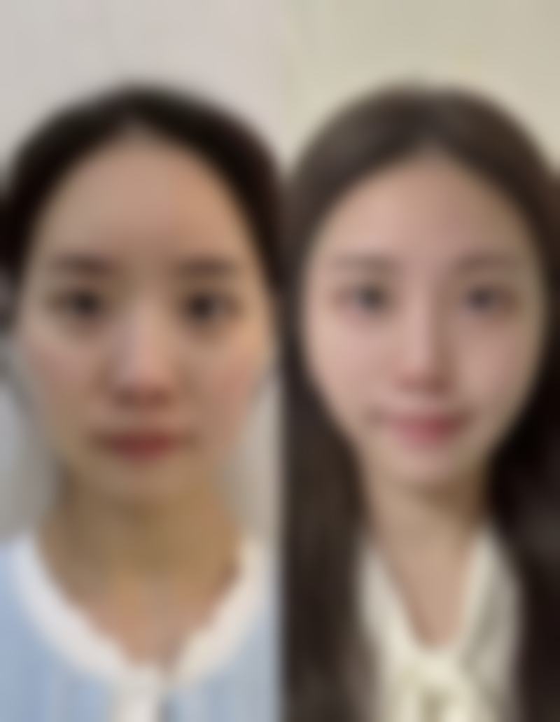 割双眼皮后 15 - 30 天，防护下适度晒太阳