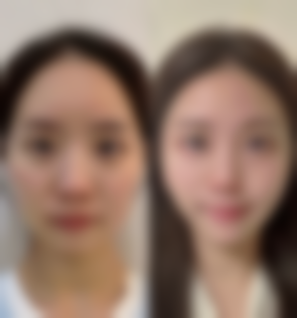 支招：术后科学管理让割双眼皮成效更持久