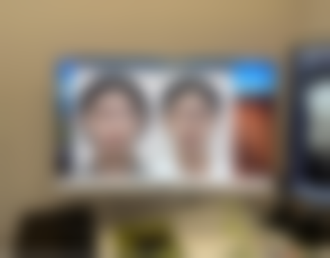 20年前埋线双眼皮，美学提示助你美