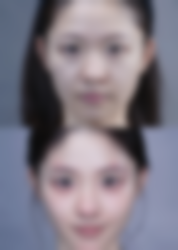 20年前埋线双眼皮，术后护理有妙招