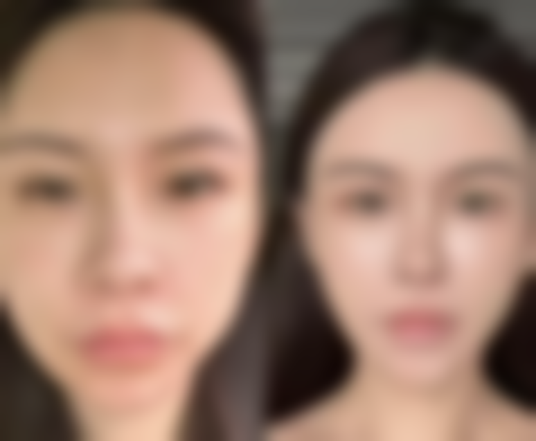 面部摔伤疤痕治疗有奇术：激光治疗创奇迹