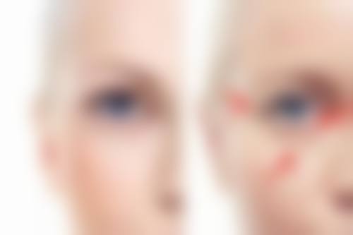 小针除皱成效的保护因素：选对医生特别重要