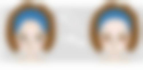 联合治疗：小针除皱搞定静态纹的秘诀