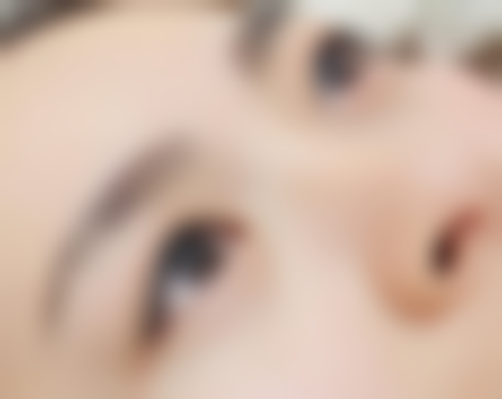 纳米无痕双眼皮线多为白色或肉色，这种颜色易被组织包裹，助你轻松拥有自然双眼皮 