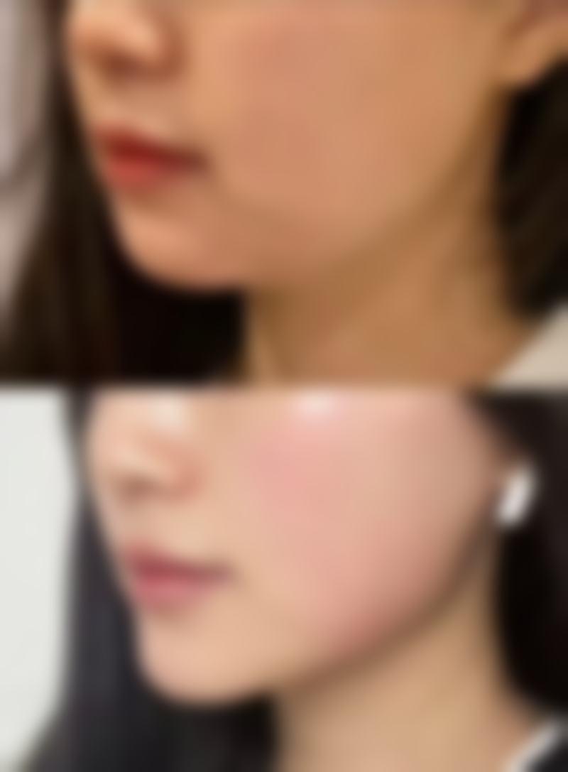 去眼袋后护理:巩固成效,保持明亮眼眸