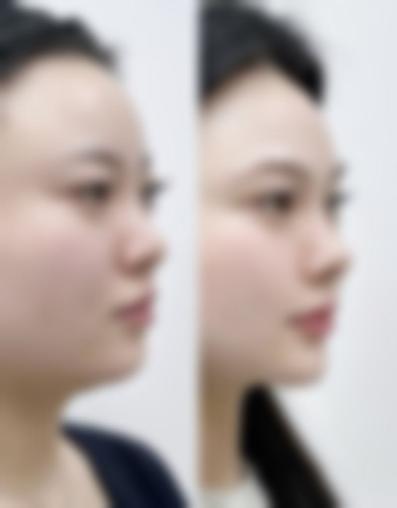 轻松攻克顽固下眼袋难题！多种方案选择，还你明亮紧致年轻眼周状态 