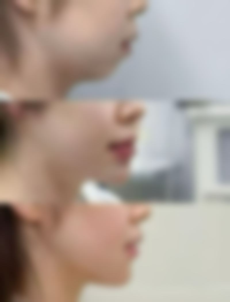 纳米无痕双眼皮线颜色选择背后的科学原理