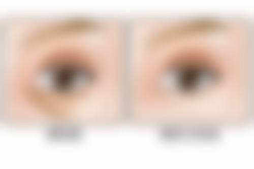 7.5 毫米双眼皮算中等偏宽吗？解密适合人群与医院选择攻略