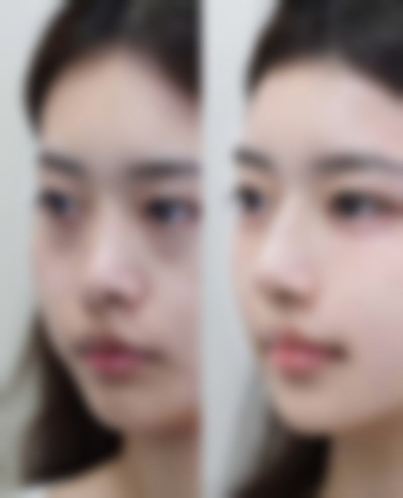 什么样的人适合割双眼皮与割眼袋同时做?