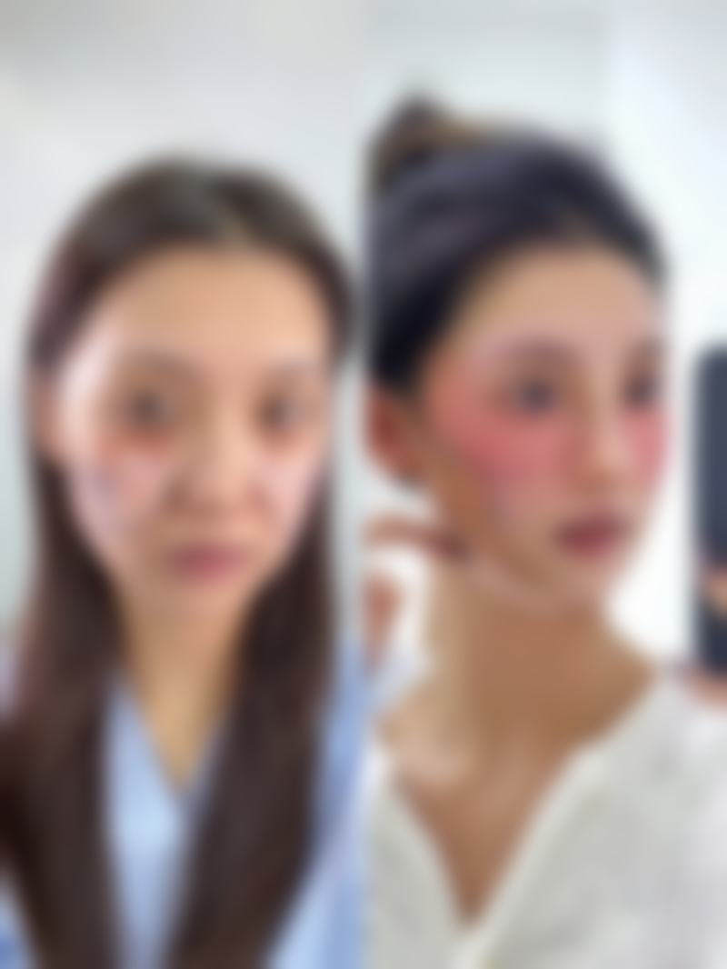 手术祛眼袋术后修复快不快?实例证明成效好