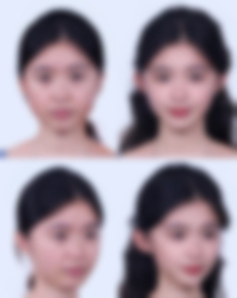 隆鼻效果能否相伴一生？揭秘不同材料隆鼻持久度及正规医院隆鼻优势 