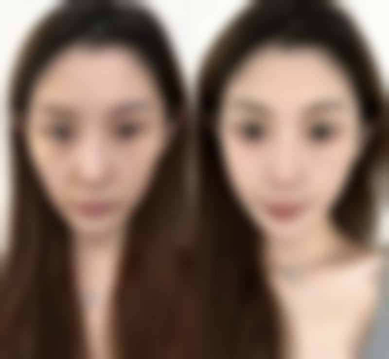 双眼皮疤痕何时淡化？手术方式对修复时间的影响