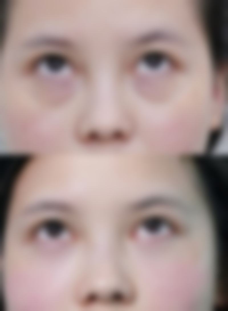 双眼皮疤痕何时淡化？个人体质差异的影响