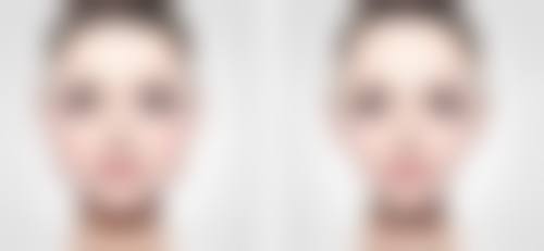 割双眼皮后眼睛闭不上别慌！多维度护理与修复方案助您恢复眼部正常闭合功能 