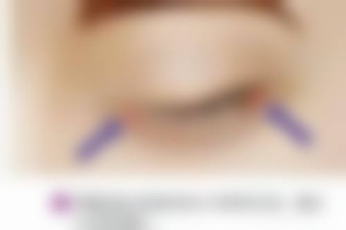 多疗法联合助切除，降低复发有保护