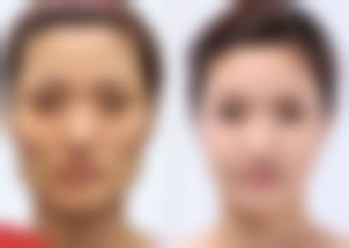 打了瘦脸针脸颊凹陷别慌！科学护理+专业修复助你重塑流畅面部轮廓