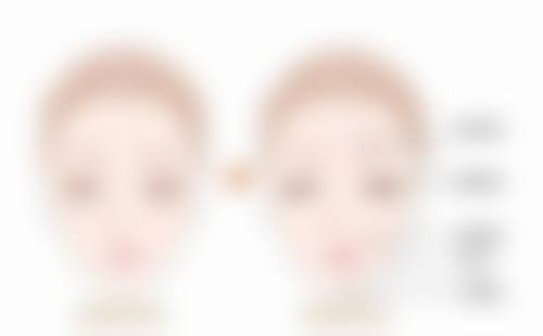 打了瘦脸针脸颊凹陷别烦!注意事项要记牢