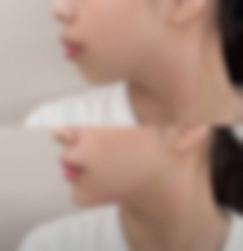 打了瘦脸针脸颊凹陷别怕!阶段性护理来帮忙