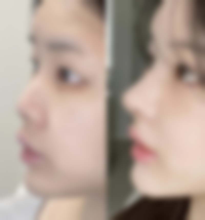 脂肪隆胸修复时间大剖析！影响修复的因素