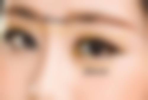 刘祥辉眼部整形实例