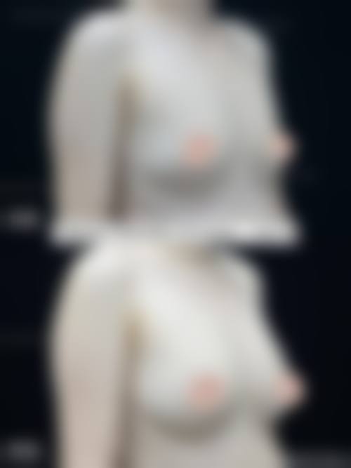 金昌英自体脂肪隆胸水平怎么样可靠吗？