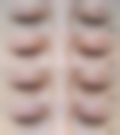 蔺娇婷埋线双眼皮魅眼定制实例