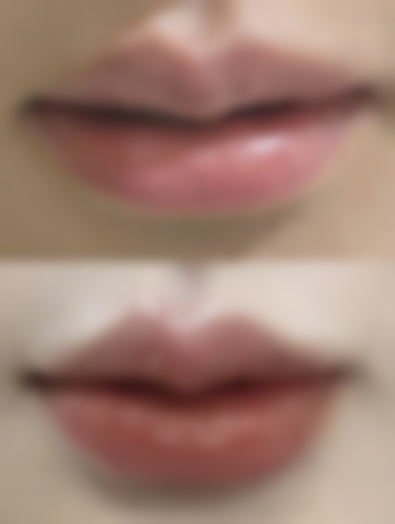 手术疤痕增生怎么治?保持耐心,重塑自信