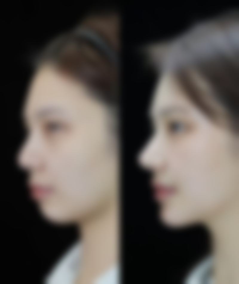 白色疤痕修复肉色有妙招?专精治疗来助力