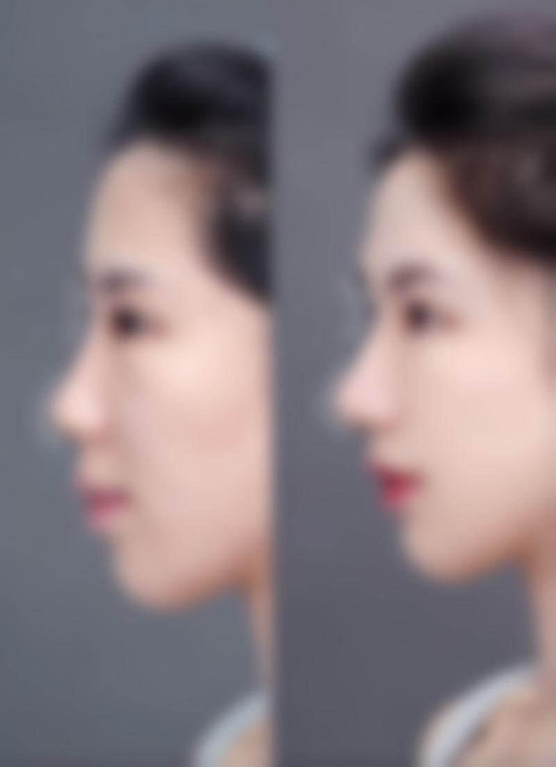 刘西富鼻部整形水平怎么样可靠吗？