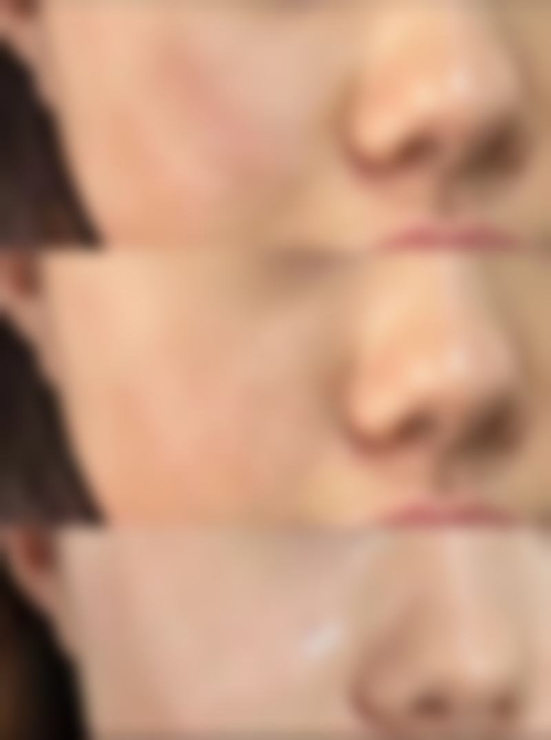 隆鼻修复期到底有多久？修复期间的日常活动安排