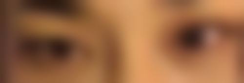 选择靠谱医院做双眼皮,术后修复更安心