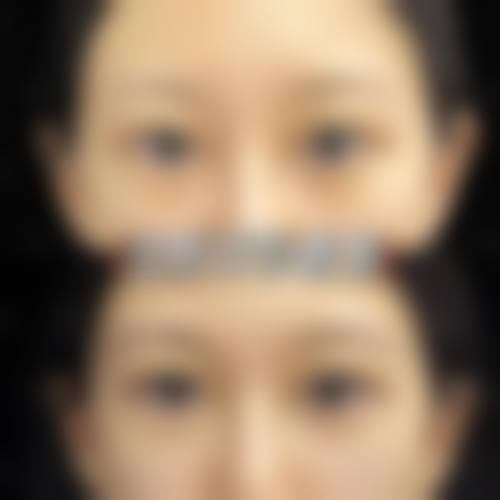 刘光源眼鼻整形实例