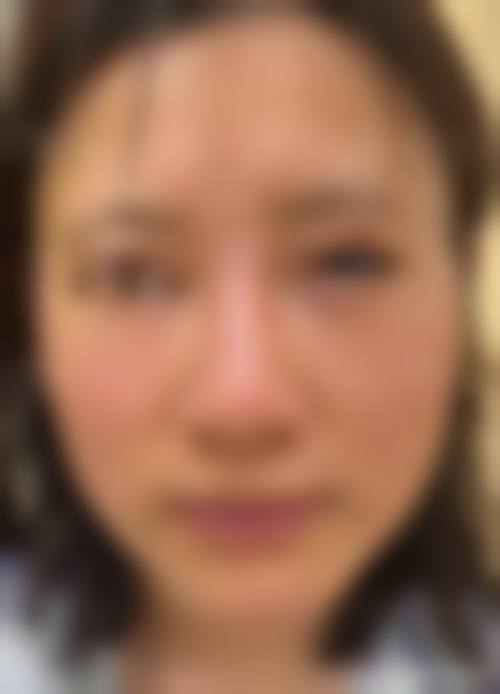 王鑫凤吸脂手术实例