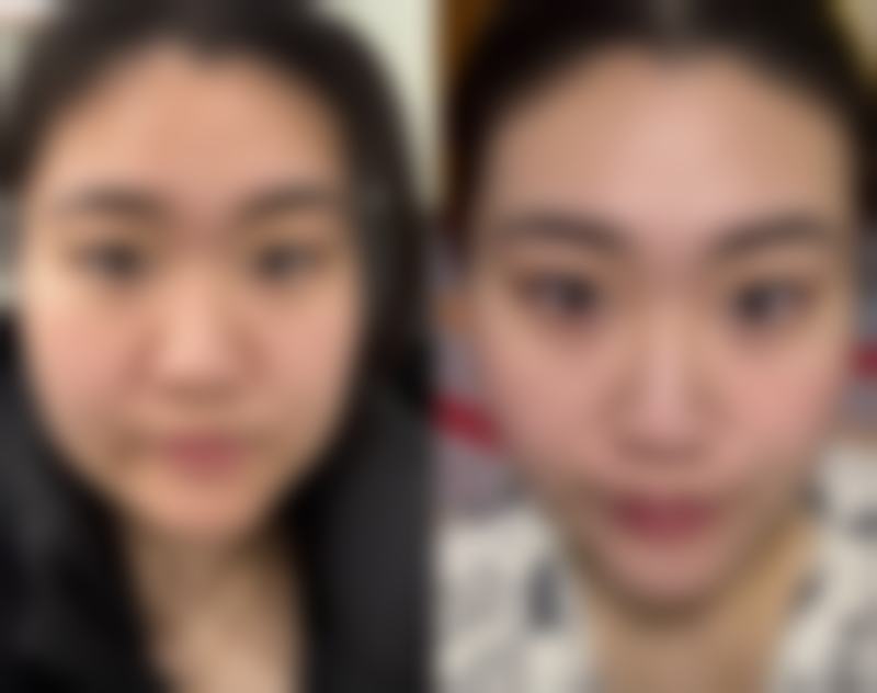 阴道紧缩手术的潜在风险:真的特别可怕吗?