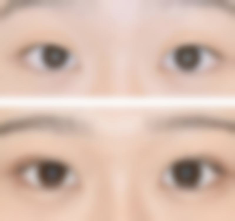 唐建华眼部整形实例