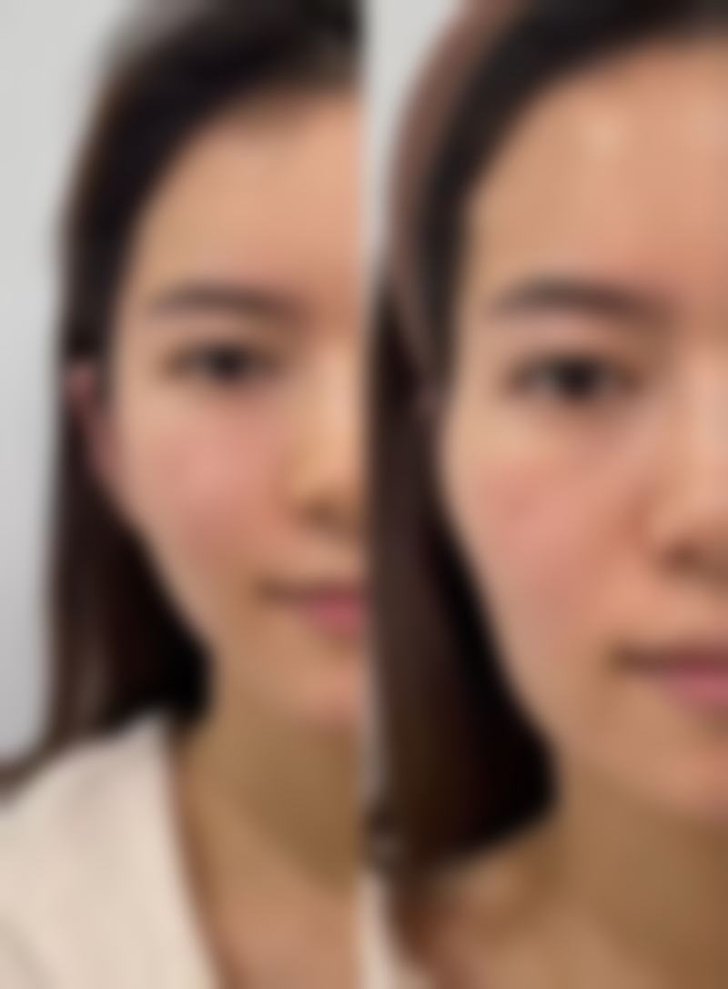 注射隆胸后能否喂母乳?选对医院特别重要