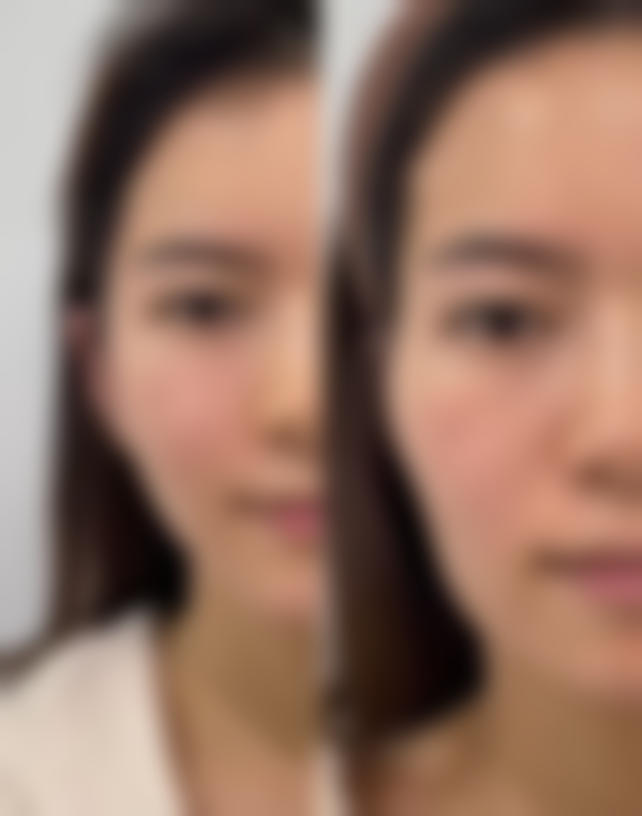 怎样把眼睛变成双眼皮?手术方案更持久