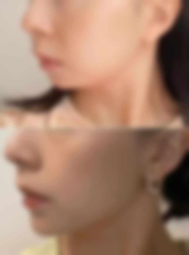 科学护理，巩固瘦脸成效