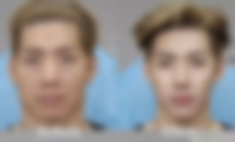 哪种方法去除眼袋成效好？手术治疗显神通