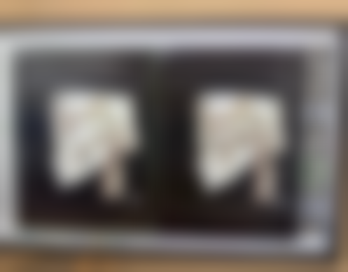 选择合适的医院做双下巴吸脂特别重要