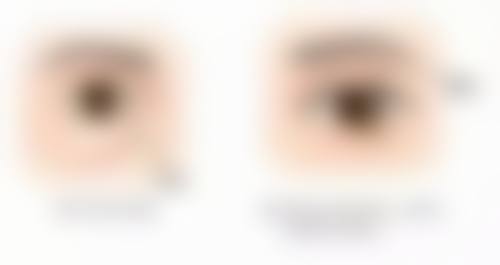 开眼角与割双眼皮费用大揭秘！受多因素影响，还附上海优质医美机构信息 