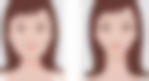 切开法修复的价格和注意事项