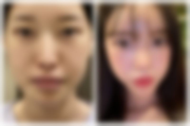 内双眼皮开眼角可行吗？开启安心变得更美之旅