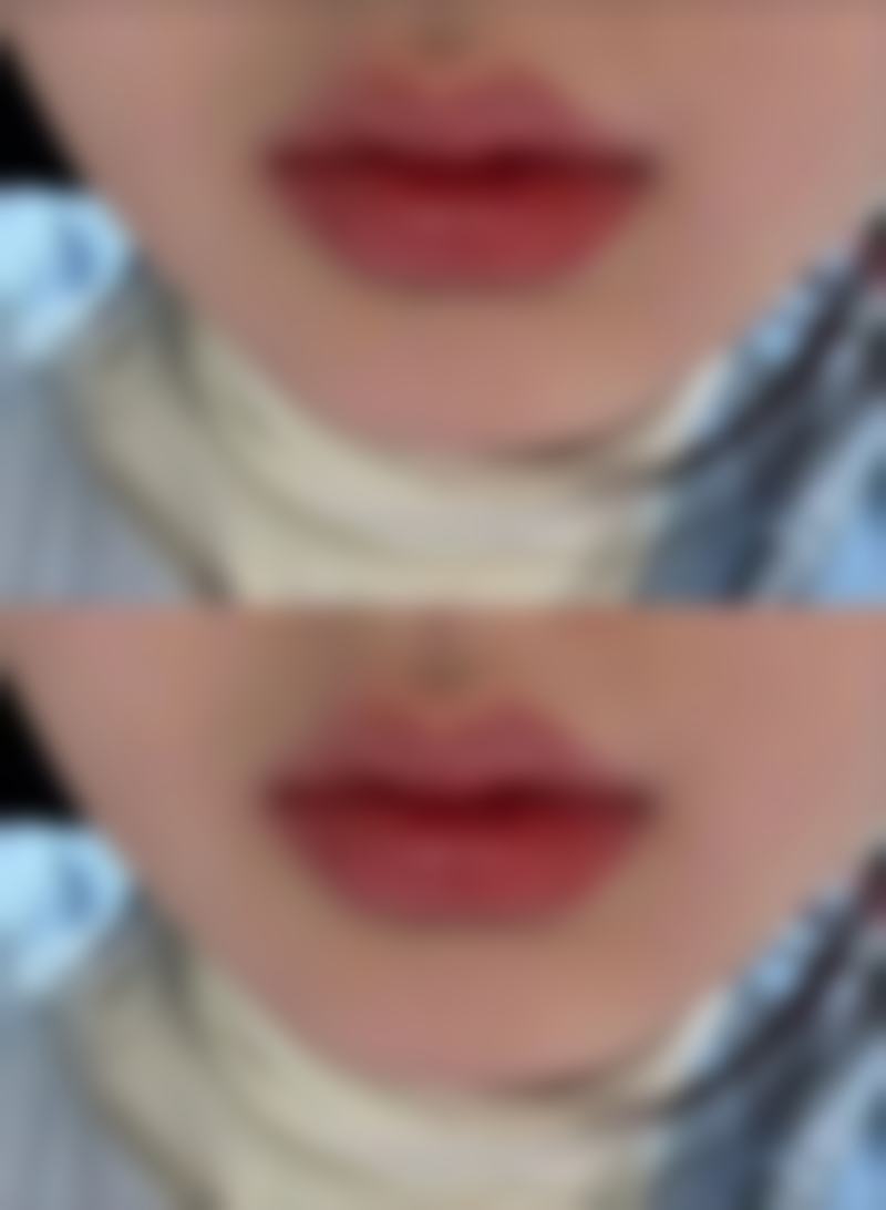 凹陷疤痕究竟如何形成？深度剖析成因与专业医院改善方案大揭秘 